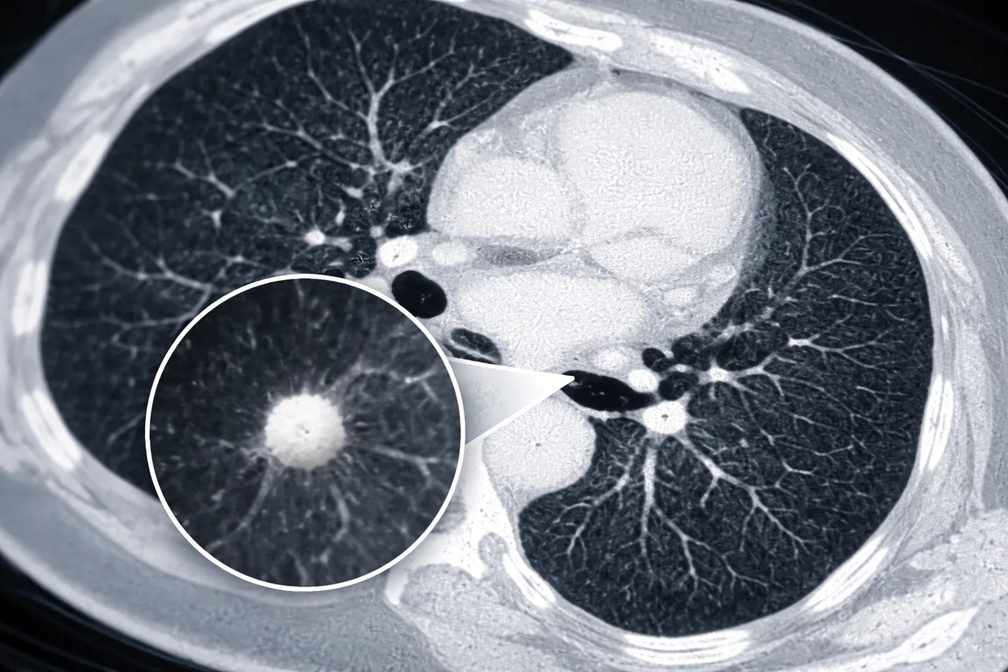 Nódulo Pulmonar: Tudo Que Você Precisa Saber. Menos de 10% dos nódulos pulmonares são malignos.